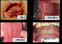 Chăm sóc răng miệng để ngăn ngừa biến chứng trong điều trị ghép tạng